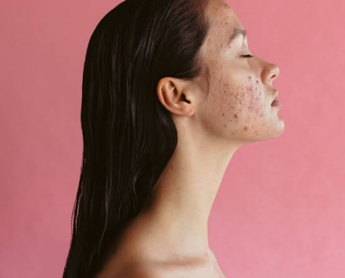 Acne 0/ Confidence 100 cover photo collage