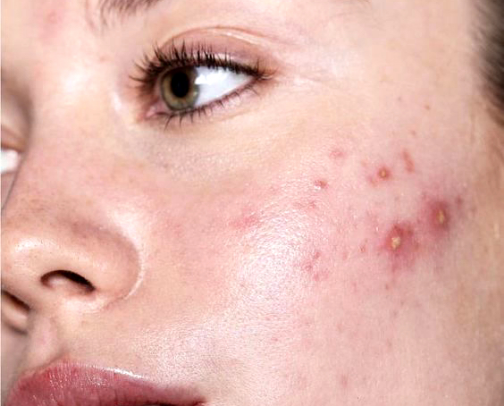 acne supplements & makeup for my hormonal acne girls🌸 cover photo collage