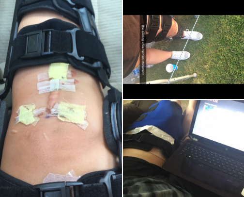 🚨 So You Tore Your ACL... Now What? 🚨 cover photo collage