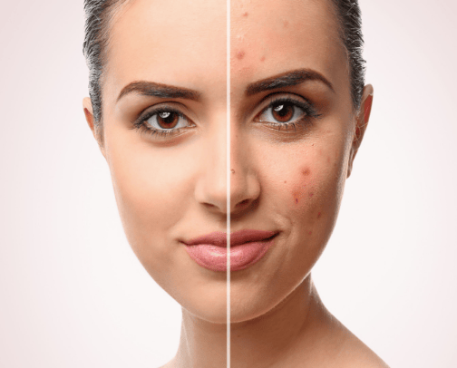 Skin care for sensitive acne prone skin ✨ cover photo collage