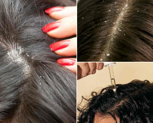 Do you have dry flaky hair? Then these are must haves! cover photo collage
