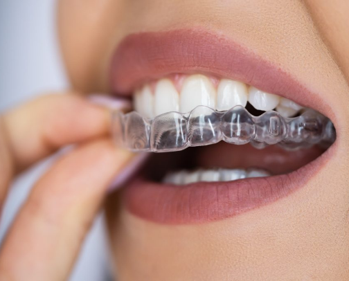 invisalign survival guide cover photo collage