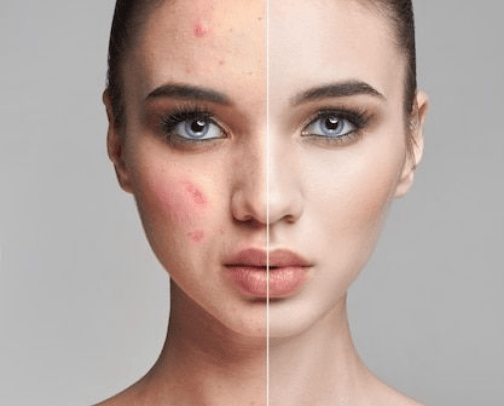 Best oily and acne prone skin products cover photo collage