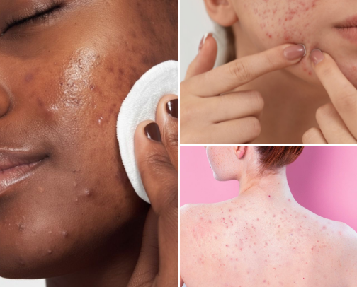 Products For Everywhere Acne cover photo collage