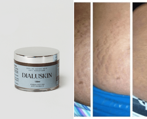 Stretch Marks cover photo collage