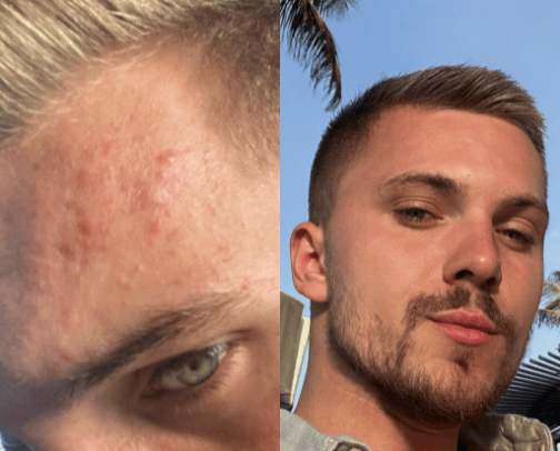 PIMPLES bye bye Skincare Routine cover photo collage