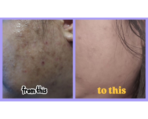 these trio that got rid of my hormonal acne and scars cover photo collage