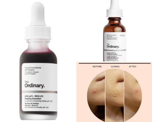 Skincare Products for Acne Prone Combination Skins! cover photo collage