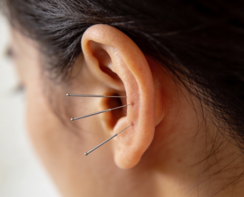 Persistent Low Back Pain Relief (65+): Why Acupuncture Is Making a Comeback cover photo collage