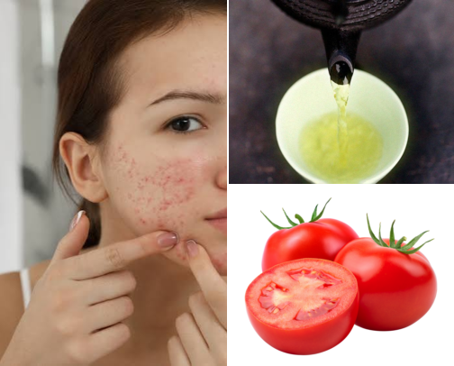 Acne remedy’s that work cover photo collage
