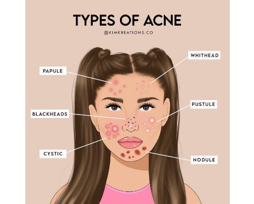 🧴✨ Acne-Prone Skin Essentials That Actually Make Sense cover photo collage