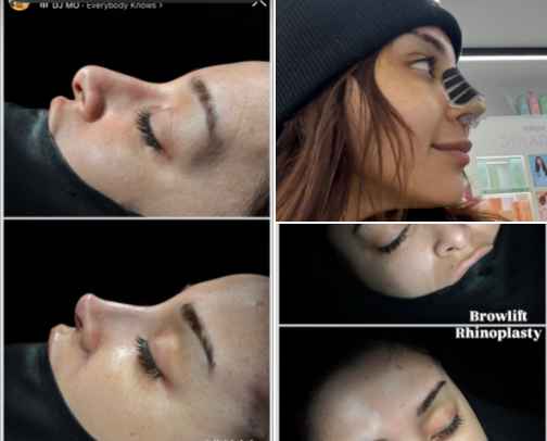 Nose job recovery aka Rhinoplasty supplies cover photo collage