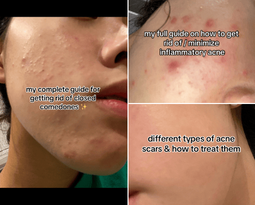 my acne tips cover photo collage