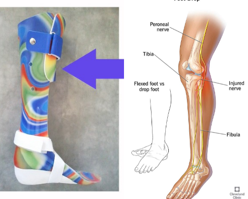 Ankle Foot Orthoses (AFOs) and Footwear Tips for Foot Drop cover photo collage