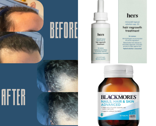 Hair loss Recs cover photo collage
