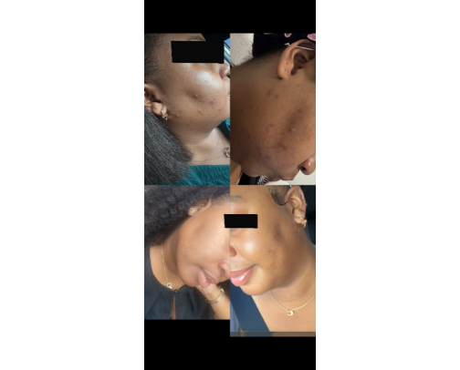 From Breakouts to Glow: My One-Month Skin Journey cover photo collage