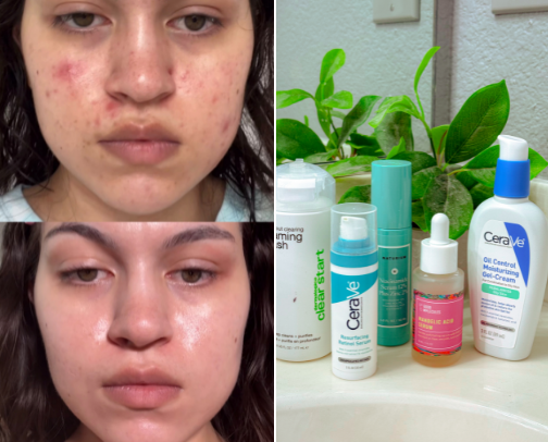 5 Step Acne Prone Night-time Skincare Routine cover photo collage