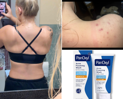 How I cured my Backne! 🔙 cover photo collage