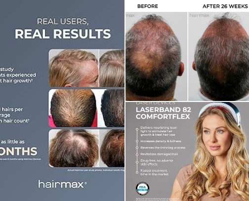 MY HAIR JOURNEY  WITH MINOXIDIL AND HAIR MAX.COM cover photo collage