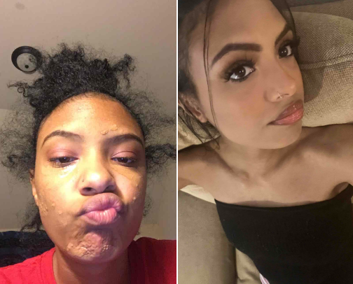 Tried & Tested Skincare Routine For Acne Prone Skin! cover photo collage