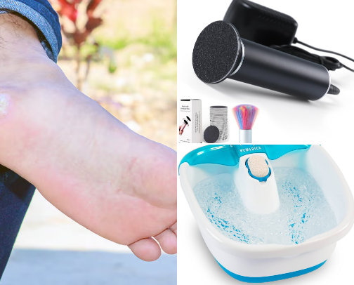 Painful calluses and hard skin to be removed, making it difficult for me to walk bare foot. A cover photo collage