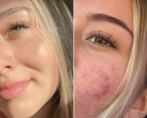 skincare that cleared my crazy acne cover photo collage