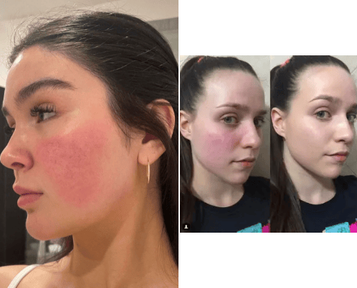 Skincare for sensitive red skin cover photo collage