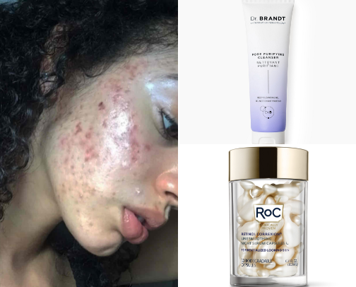 Top skincare for ACNE cover photo collage