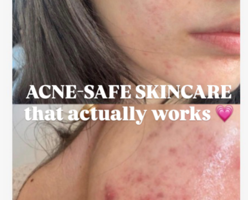 Acne-Safe Skincare That Actually Works 💗 + Drugstore Favorites cover photo collage