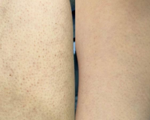 Bye bumpy chicken skin cover photo collage