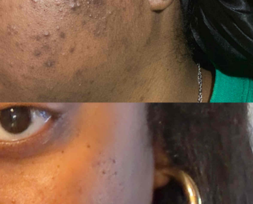 your one stop shop for getting rid of dark marks and acne scars cover photo collage