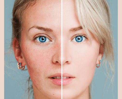 Redness Rescue: Rosacea-Friendly Skincare cover photo collage