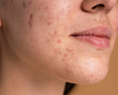 Damaged skin barrier? Here's what you need! cover photo collage