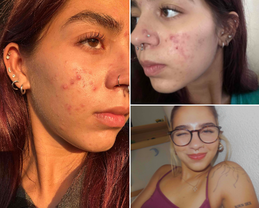 CYSTIC ANCE TREATMENT cover photo collage