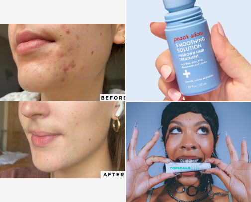 How I cleared my skin🧴 cover photo collage