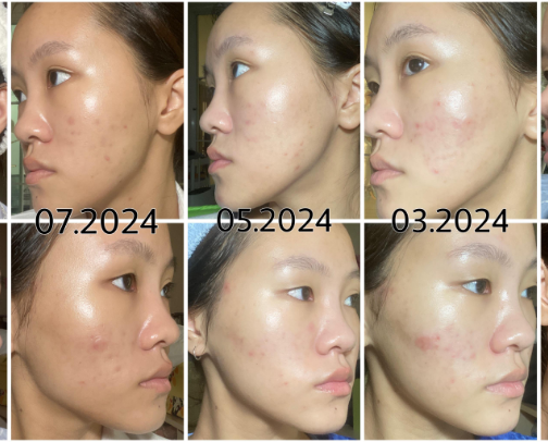 The hype is REAL… ask your derm about Tret or any retina serum/cream cover photo collage