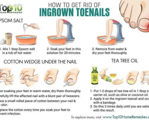 10 Remedies for Ingrown Toenails cover photo collage