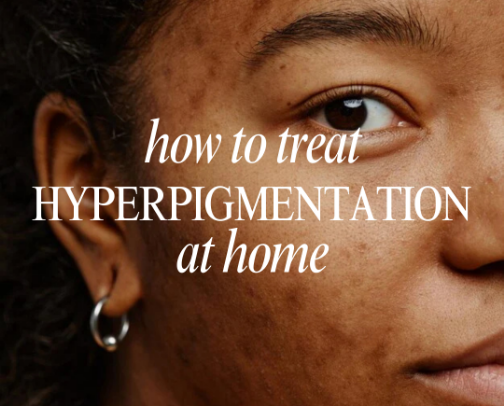 hyperpigmentation guide cover photo collage