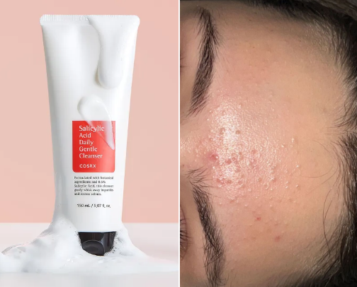 Best Products for Clogged Pores, Tiny Bumps & Small Pimples cover photo collage