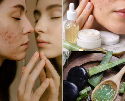 ❣️Clear Skin Routine: Expert Solutions for Acne & Blackheads❣️ cover photo collage