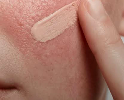 Best skincare and makeup for redness. cover photo collage