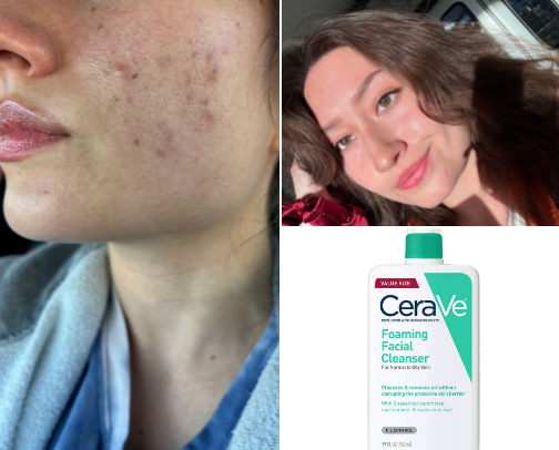 Best Sensitive Skin Skincare for Healing Acne Scars and Irritation cover photo collage