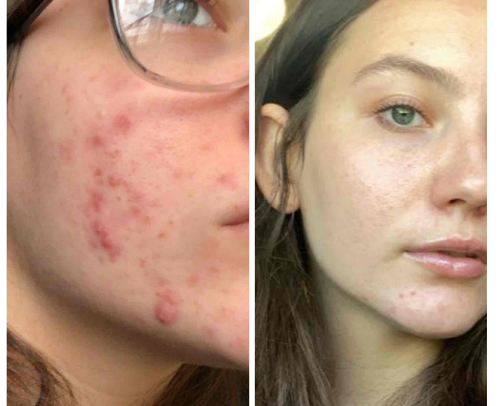 Best products for a cystic acne girlie 💕🎀 cover photo collage