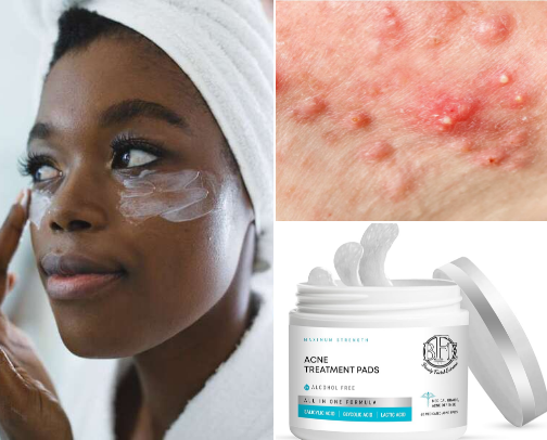 Works faster acne removal cover photo collage