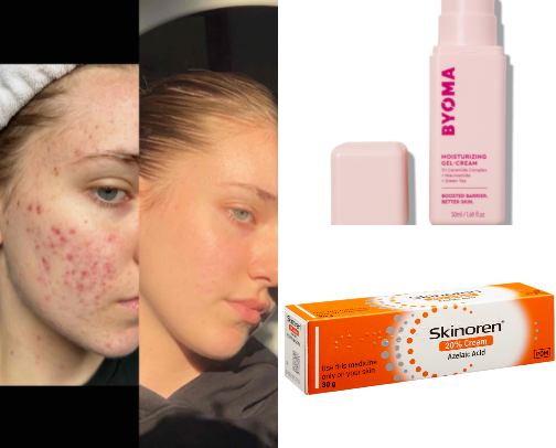 Budget-friendly skincare for Acne Prone Skin!🧴⭐️ cover photo collage