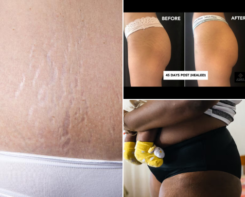 stretch marks cover photo collage