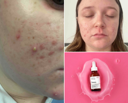 Everything skincare and make-up | journey to reduce clogged pores and be eczema free cover photo collage