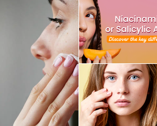 Best Skincare for Acne cover photo collage