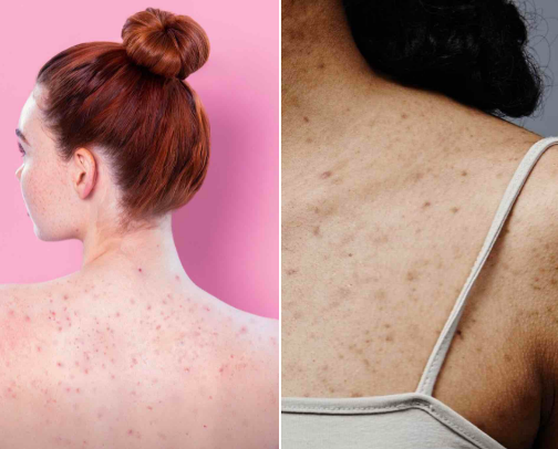 STRUGGLING WITH BODY ACNE?(Here's what worked magic for me)!😽❤️ cover photo collage