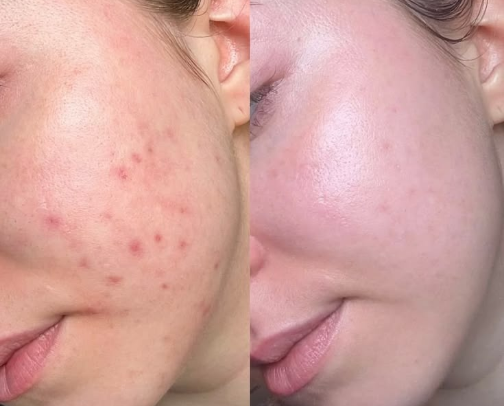 My Acne Journey: Skincare Products That Actually Healed My Skin cover photo collage